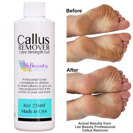 Callus Remover Extra Strength Gel for Feet